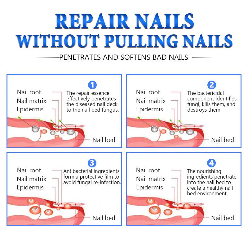The Most Trusted Nail Fungus Solution 🌟 Clear, Strong & Healthy Nails Start Here-Powerful Ginger Nail Treatment