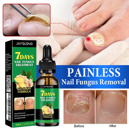 The Most Trusted Nail Fungus Solution 🌟 Clear, Strong & Healthy Nails Start Here-Powerful Ginger Nail Treatment