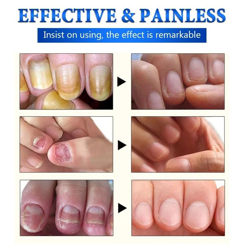 The Most Trusted Nail Fungus Solution 🌟 Clear, Strong & Healthy Nails Start Here-Powerful Ginger Nail Treatment