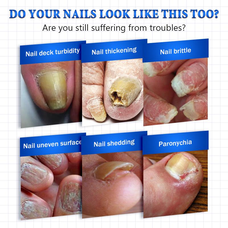 The Most Trusted Nail Fungus Solution 🌟 Clear, Strong & Healthy Nails Start Here-Powerful Ginger Nail Treatment